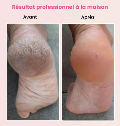 Résultat avant après